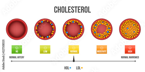 Creative vector illustration of Cholesterol in artery, heart fat, health risk, blood flow, vessels concept. Clogging cholesterol arteries template. Abstract graphic plaque in blood vessels element