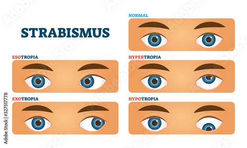 Strabismus or cross eyed vision condition, vector illustrations