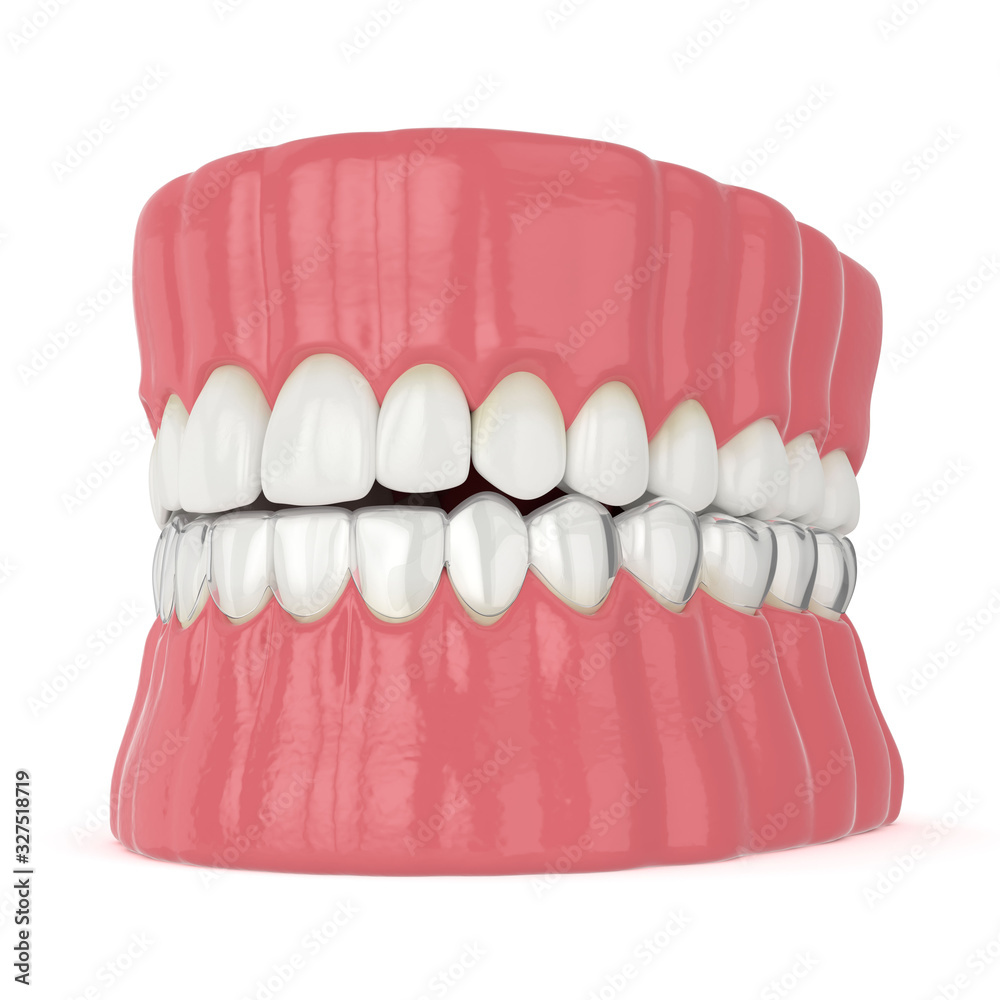 Obraz premium 3d render of jaw with invisalign removable retainer