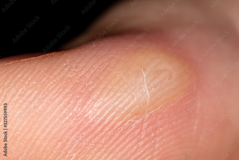 Corn on a finger isolated on a black Corn on a finger isolated on a black