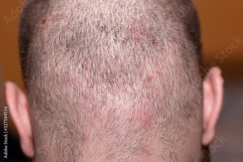 Back side of a man's head suffering from scalp acne