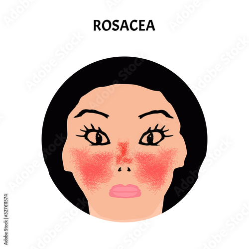 Rosacea. Rosacea Awareness Month. Infographics. Vector illustration on isolated background.