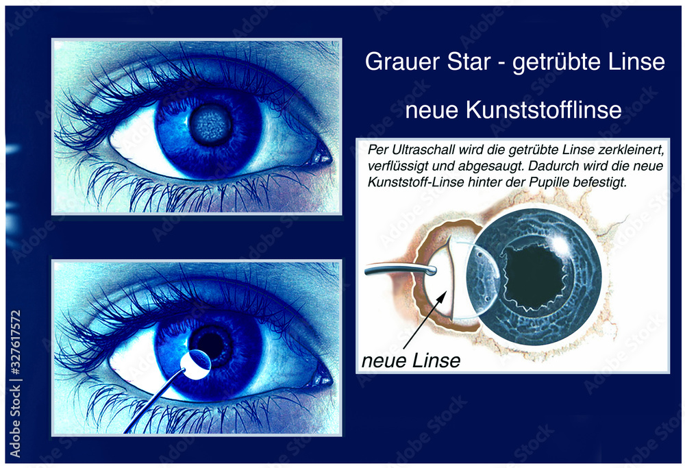 Grauer Star Getr bte Linse Stock Illustration Adobe Stock Grauer Star Getr bte Linse Stock Illustration Adobe Stock
