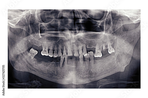 Panoramic dental x-ray of an elderly person. Bad teeth fell out. Snapshot of the pensioner's jaw. Orthopantomogram.