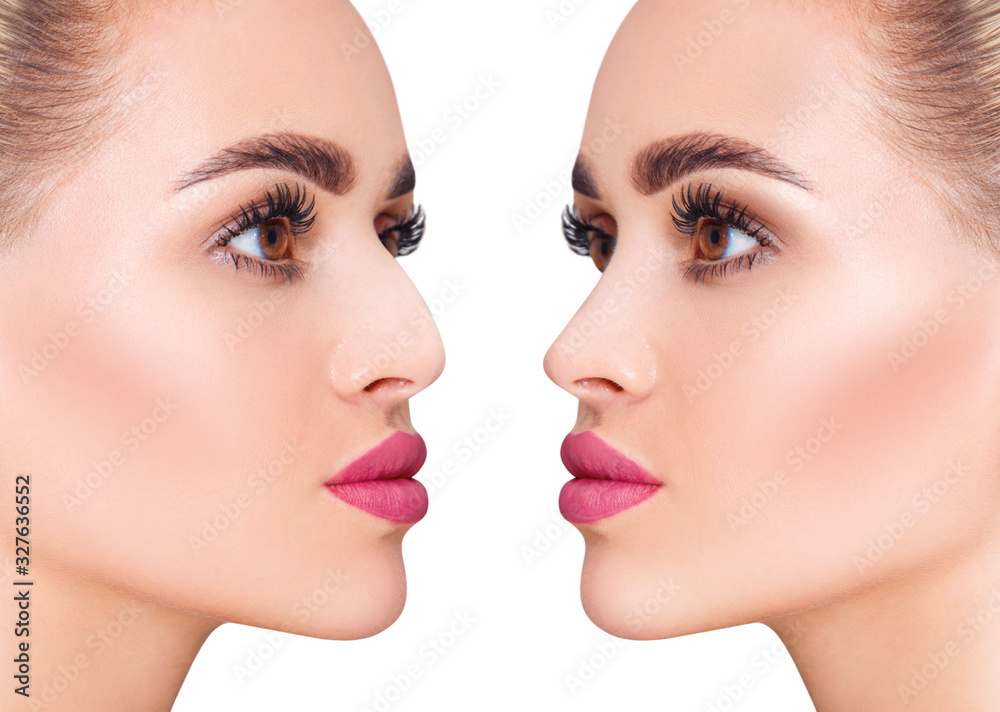 Beautiful woman before and after plastic surgery on nose.
