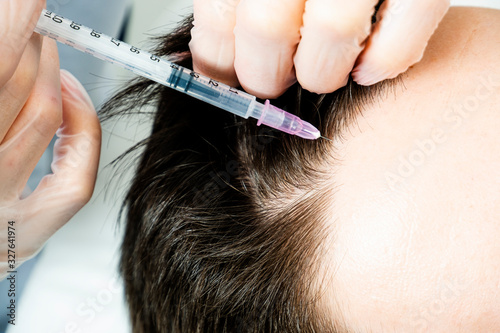 Procedure for stimulating hair growth mesotherapy. Hair transplant in men.