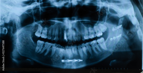 Panoramic X-ray of the jaw after fracture and osteosynthesis with the installation of titanium plates. Selective focus. Blur. Noise, sharpness and grain are typical for X-rays. Horizontal orientation.