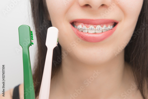 Cleaning teeth with dental braces by brushes. Happy woman with brackets on the teeth after whitening. Self-ligating brackets with metal ties and gray elastics or rubber bands for perfect smile