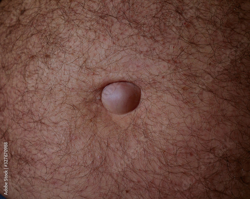Medical examination of the patient's umbilical hernia of the abdomen