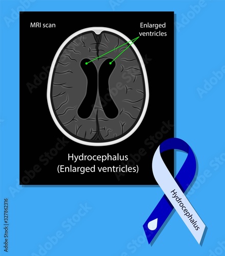 Hydrocephalus brain cerebrospinal fluid  (CSF) drain head
