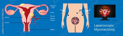 laparoscopic hysterectomy medical surgical treat cervix ovary subtotal minimally invasive procedure MIP Open UFE tumor agents diagnosis UAE guided Focused Ultrasound ovarian pcos pmdd cysts