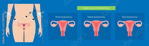 laparoscopic hysterectomy medical surgical treat cervix ovary subtotal minimally invasive procedure MIP Open UFE tumor agents diagnosis UAE guided Focused Ultrasound ovarian pcos pmdd cysts