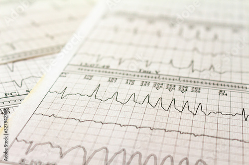 Photos Electrocardiogram strips with cardiac arrhythmias