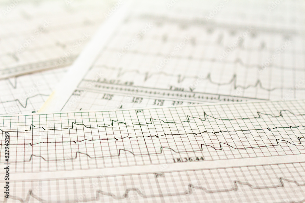 Electrocardiogram strips with cardiac arrhythmias. Acute myocardial infarction. Selective focus on some beats. Free space to write.