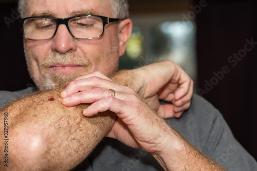portrait of a man with healing skin cancer scar
