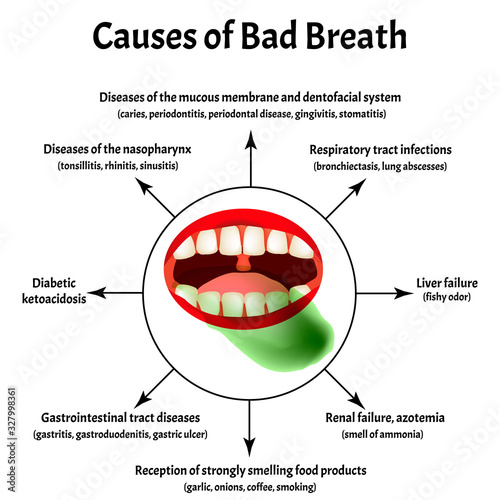 Causes of bad breath. Halitosis. The structure of the teeth and oral cavity. Diseases of the teeth. Infographics. Vector illustration on isolated background.