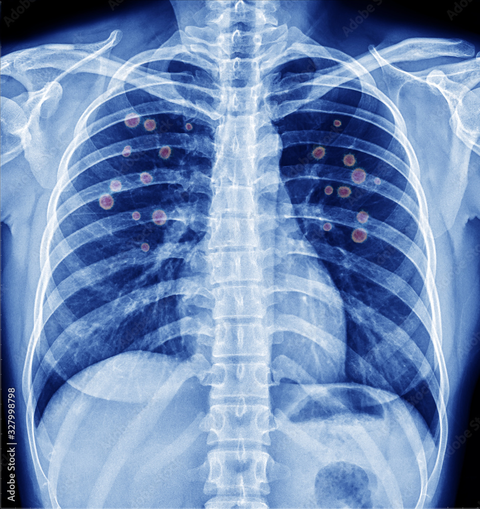 Novel Covid19, Wuhan virus concept , Chest xray Coronavirus of lungs