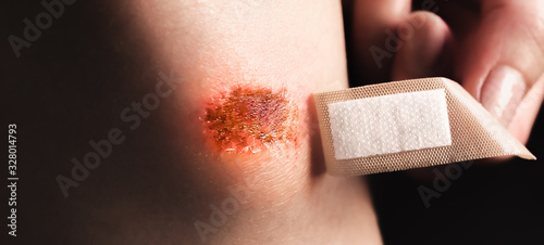 Abrasion on the woman's knee. Girl is applying antiseptic band-aid plaster on the injured leg with a red wound. Medical treatment.