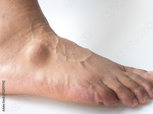 Big ganglion cysts,a sac of jellylike fluid,is on the right foot of man put on the white background. photo