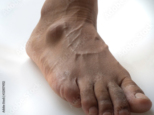 Big ganglion cysts,a sac of jellylike fluid,is on the right foot of man put on the white background.