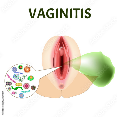 Vaginitis. Female genital inflammation. The structure of the reproductive organs. Vaginitis vaginal dysbiosis. Bad smell. Infographics. Vector illustration on isolated background.
