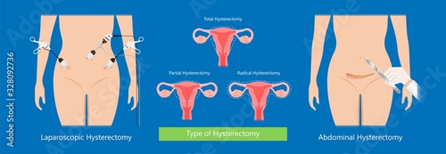 laparoscopic hysterectomy medical surgical treat cervix ovary subtotal minimally invasive procedure MIP Open UFE tumor agents diagnosis UAE guided Focused Ultrasound ovarian pcos pmdd cysts