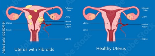laparoscopic hysterectomy medical surgical treat cervix ovary subtotal minimally invasive procedure MIP Open UFE tumor agents diagnosis UAE guided Focused Ultrasound ovarian pcos pmdd cysts