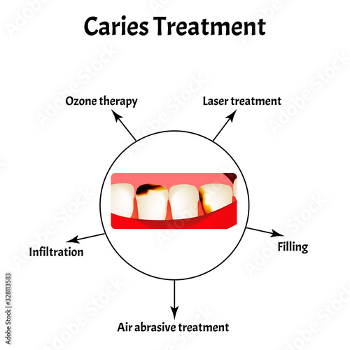 Caries treatment. Bad breath. Halitosis. The structure of the teeth and oral cavity with caries. Diseases of the teeth. Infographics. Vector illustration on isolated background.