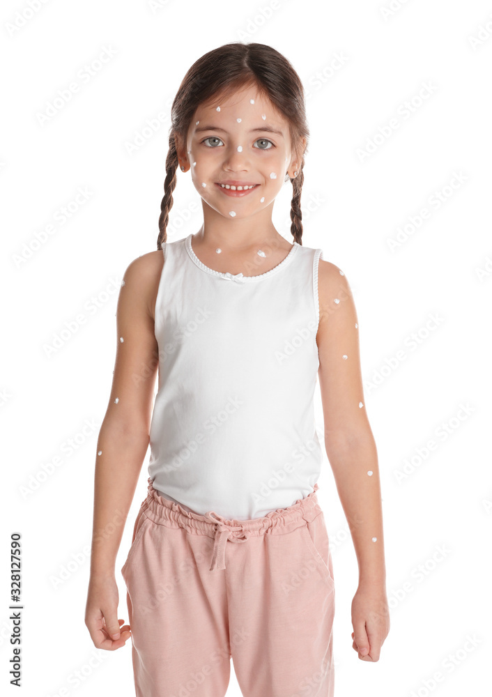Little girl with chickenpox on white background Little girl with chickenpox on white background