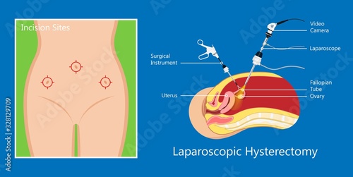 laparoscopic hysterectomy medical surgical treat cervix ovary subtotal minimally invasive procedure MIP Open UFE tumor agents diagnosis UAE guided Focused Ultrasound ovarian pcos pmdd cysts