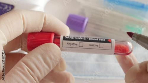 checking positive result of blood test for coronavirus, covid-19, sars-cov-2