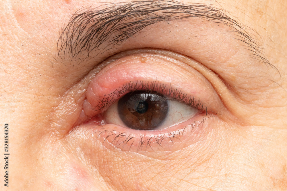 Obraz premium Macro shot of red and swollen chalazion in open woman eye. Closeup of upper eyelid inflammation caused by viral infection. Glossy caucasian skin. Medicine and healthcare concept.
