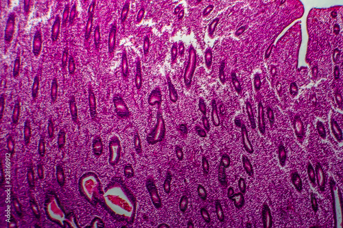 Endometrial hyperplasia, light micrograph photo