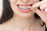Applying orthodoentic wax on the dental braces. Brackets on the teeth after whitening. Self-ligating brackets with metal ties and gray elastics or rubber bands for perfect smile.