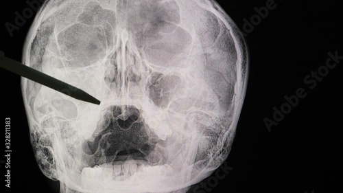 A doctor using a pen to point at a paranasal sinus flim of a patient with acute sinusitis of his right maxillary sinus. photo