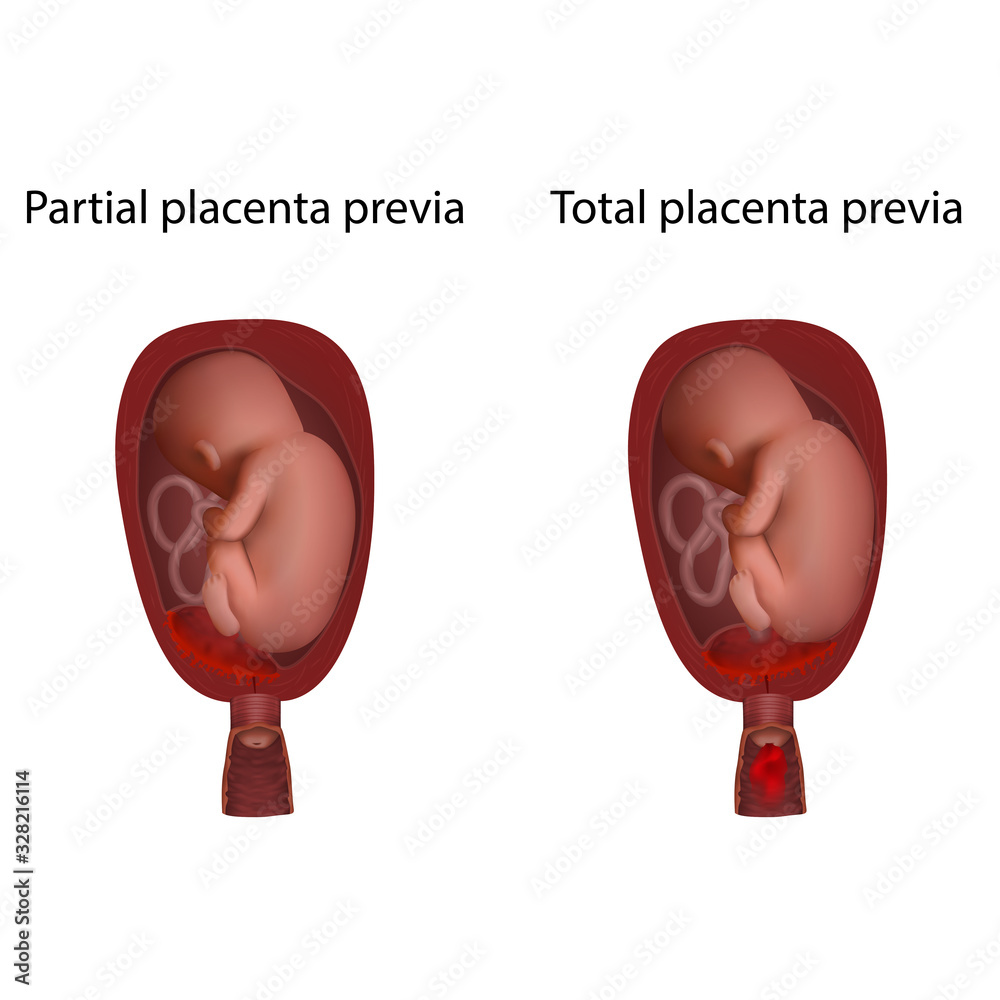 Partial and total placenta previa. Fetus in uterus, womb, placenta ...