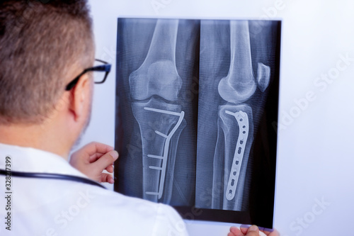 A male doctor examines an x-ray of the lower leg with a plate after surgery photo