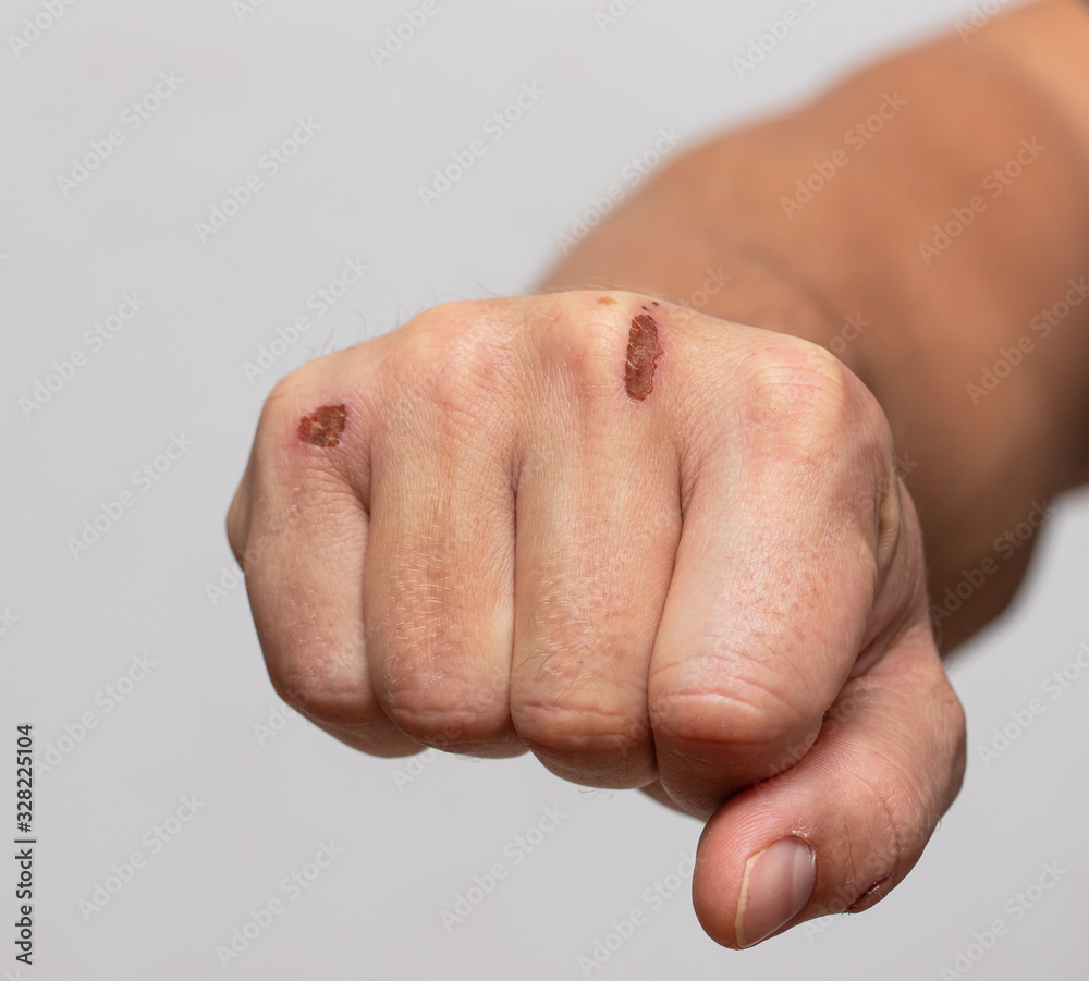 Fototapeta premium skin damage on the arm