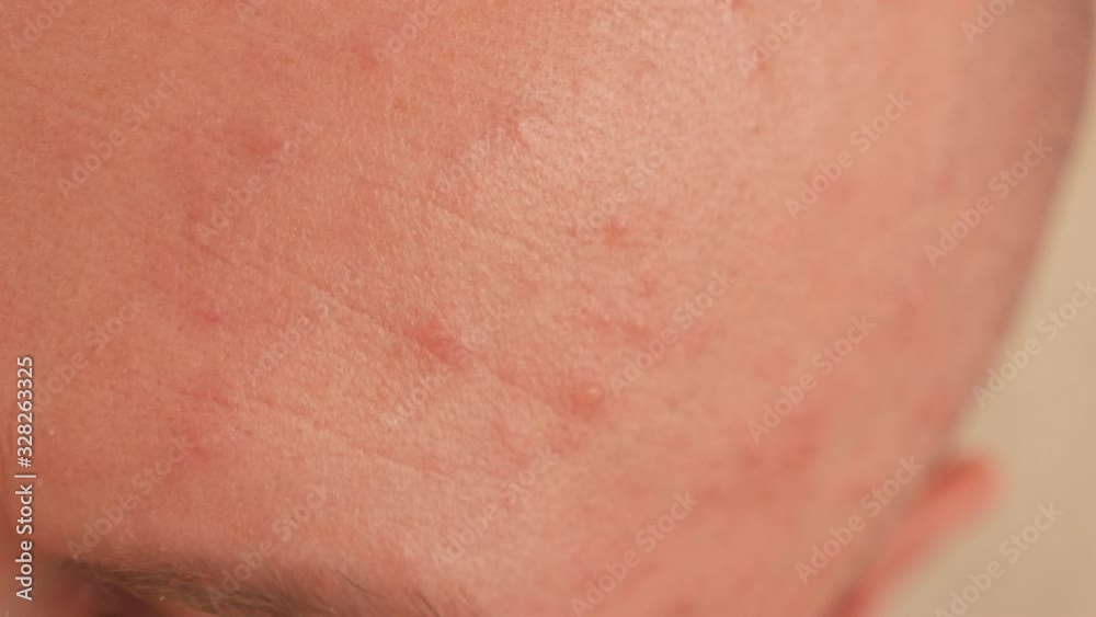 Close-up of large rashes or pockmarks on the skin of an adult male. A person has chickenpox and has many red spots on his skin. Close-up of large rashes or smallpox on the skin of an adult male. Close-up of large rashes or pockmarks on the skin of an adult male. A person has chickenpox and has many red spots on his skin. Close-up of large rashes or smallpox on the skin of an adult male.