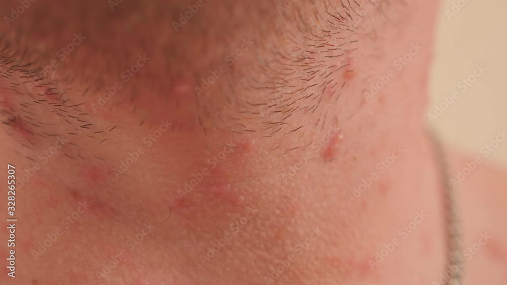 Close-up of many red rashes in chickenpox on the skin of an adult male ...