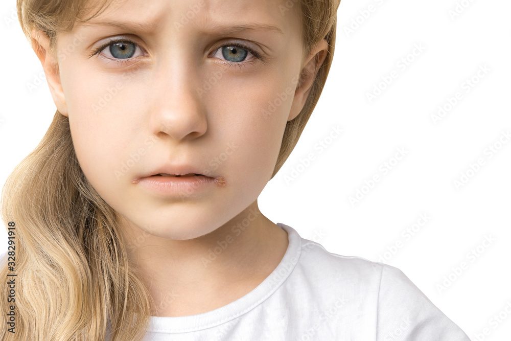 Close-up portrait of charming sad little sick girl with herpes sores on corners of her lips posing on a white background. Seasonal illness concept. Common cold and weak immunity concept. Copyspace Close-up portrait of charming sad little sick girl with herpes sores on corners of her lips posing on a white background. Seasonal illness concept. Common cold and weak immunity concept. Copyspace