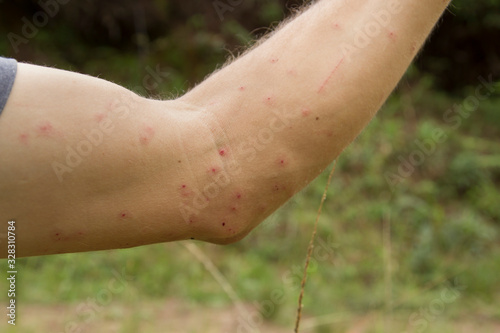 white man showing his arm with hives marks due to mosquito bites