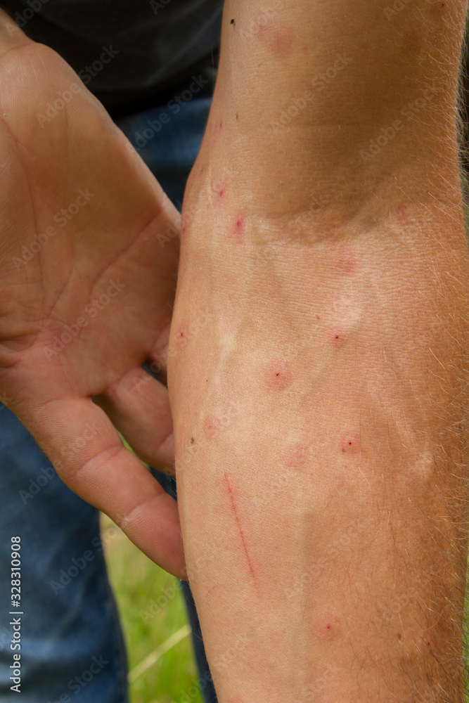 white man showing his arm with hives marks due to mosquito bites white man showing his arm with hives marks due to mosquito bites