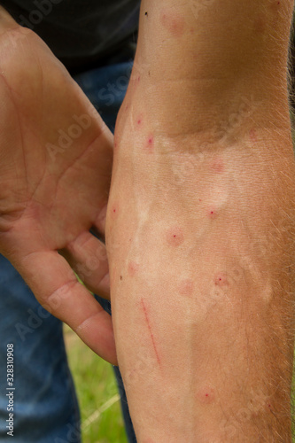 white man showing his arm with hives marks due to mosquito bites