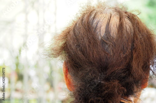 Closeup back side of an old woman with her hair loss at the top of the head due to getting old age and hair coloring. Grey hair also found when growing old. Medical and healthcare concept