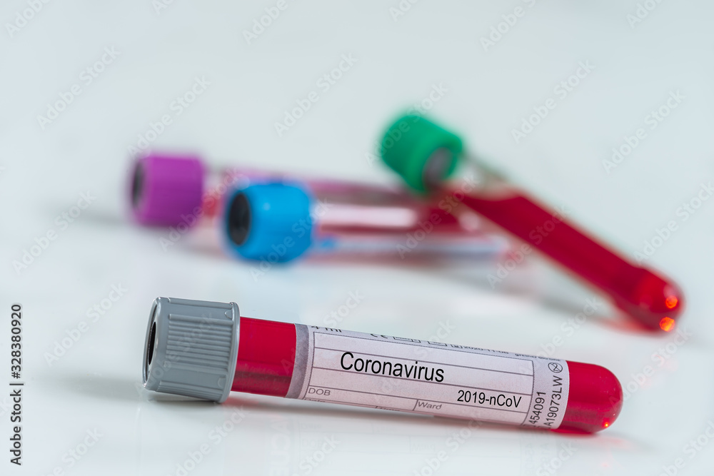 Medical laboratory test tube with blood , concept of virology, epidemic, spread of the CoV virus Medical laboratory test tube with blood , concept of virology, epidemic, spread of the CoV virus