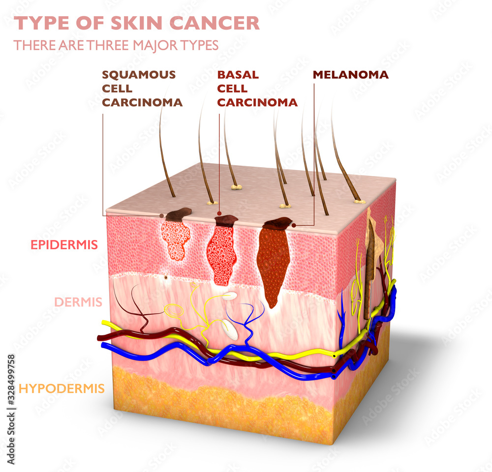 Skin tumors, moles and spots, 3d section of the skin layer. Three types of skin  cancer, squamous cell carcinoma, basal cell carcinoma, melanoma. 3d render  Stock Illustration | Adobe Stock