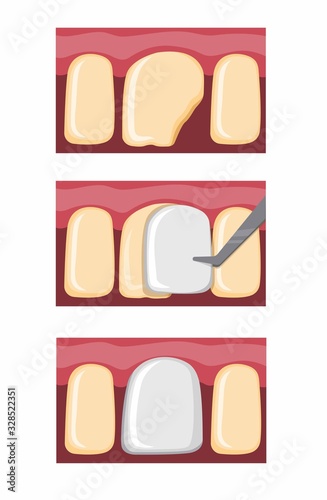 veneer teeth procedure, dental filling on broken tooth cartoon flat illustration vector isolated in white background