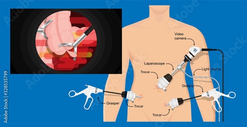appendectomy medical surgery organ colon tool heal room body doctor pain scars liver cancer tummy tumor mass trocars nurse pelvic video health system display urology monitor endoscopic cholecystitis