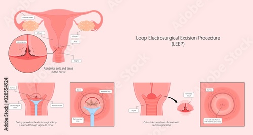 Cold knife cone biopsy Loop Electrosurgical Excision Procedure LEEP Large Loop Excision of the Transformation Zone LLETZ remove tissue from the cervix for precancerous cell laser diathermy per treat photo